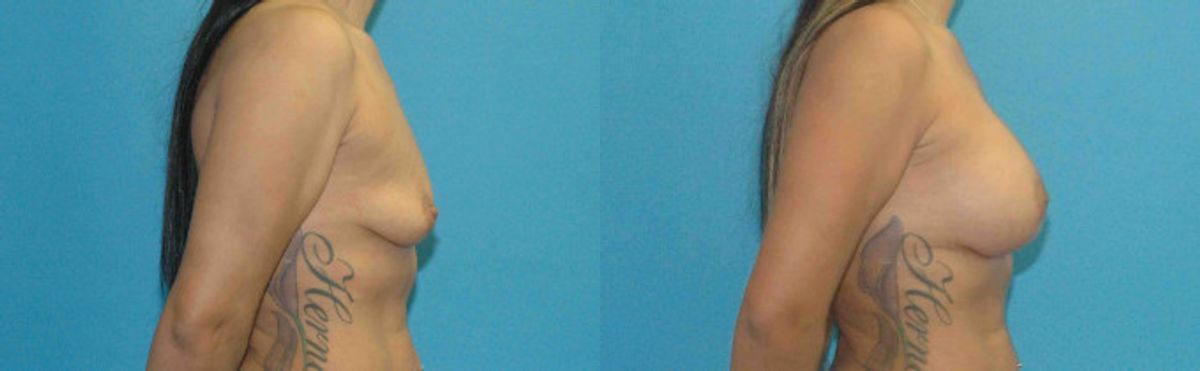 Breast Implant #70 - Before and After