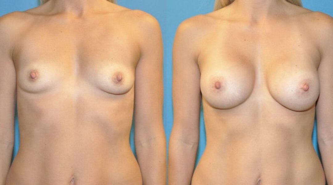 Breast Implant #71
