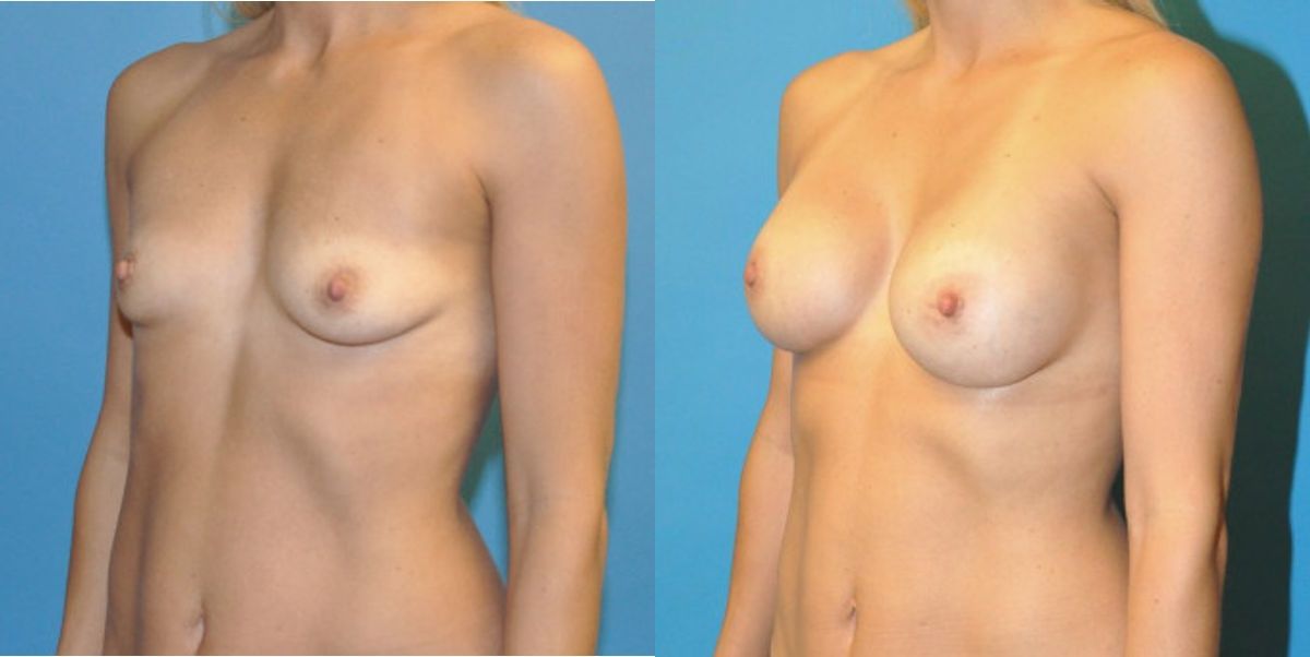 Breast Implant #71 - Before and After