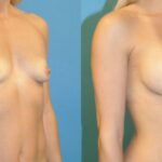 Breast Implant #71 - Before and After