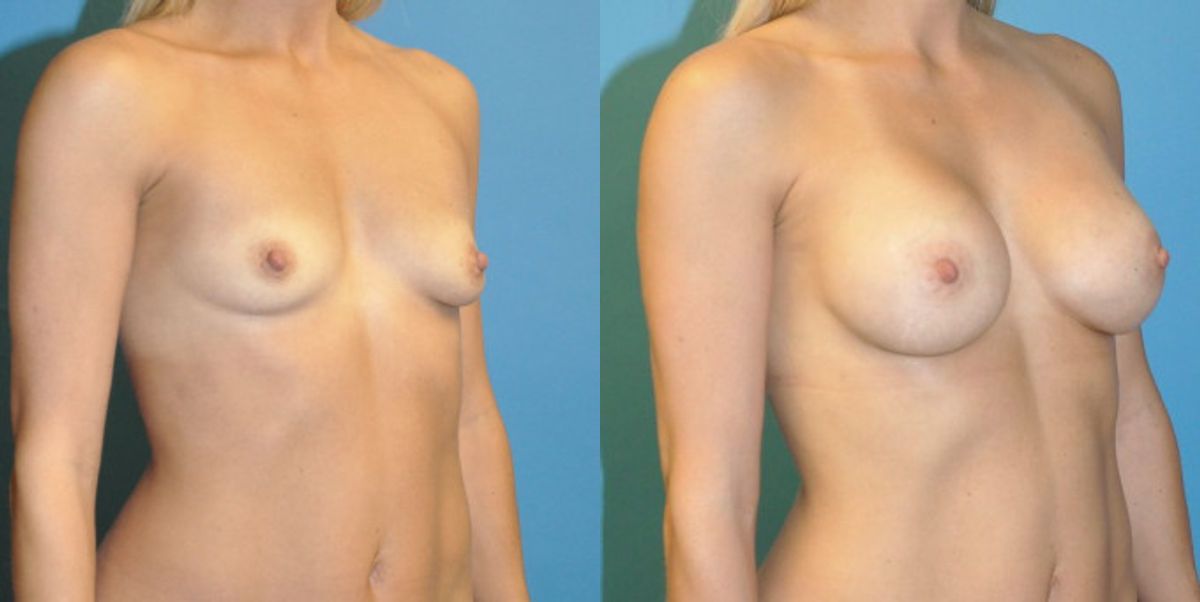 Breast Implant #71 - Before and After