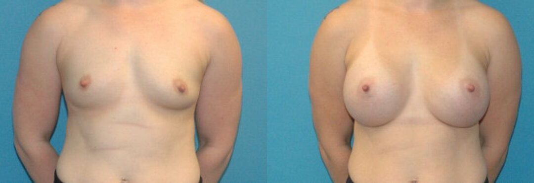 Breast Implant #72