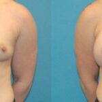 Breast Implant #72 - Before and After