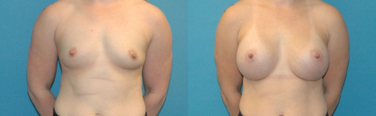 Breast Implant #72 - Before and After