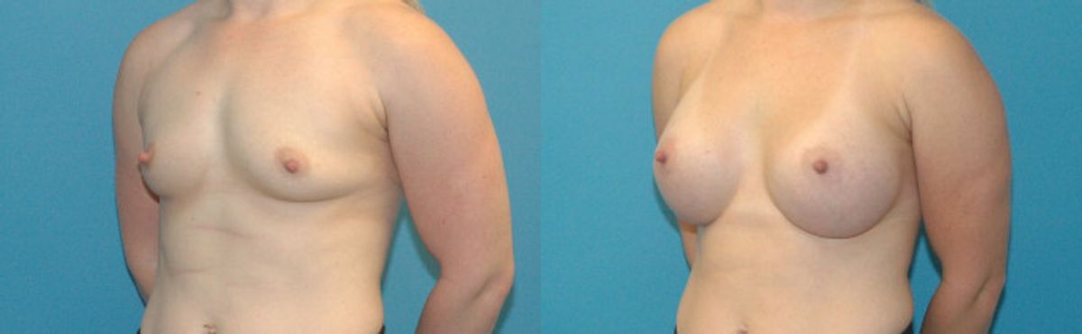 Breast Implant #72 - Before and After