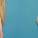 Breast Implant #72 - Before and After