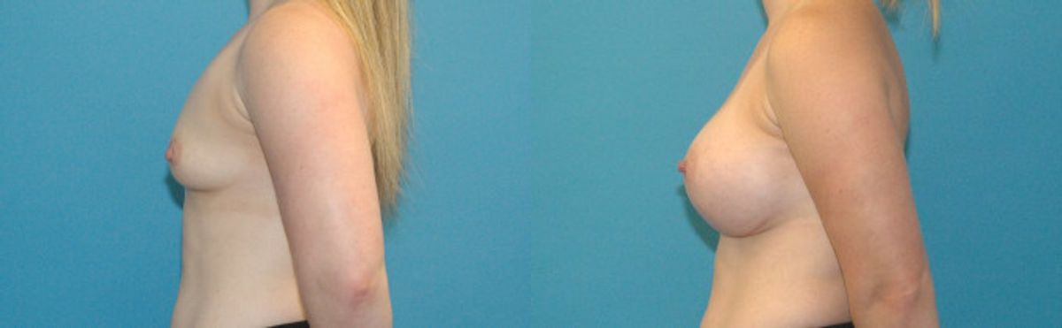 Breast Implant #72 - Before and After
