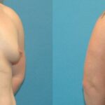 Breast Implant #72 - Before and After