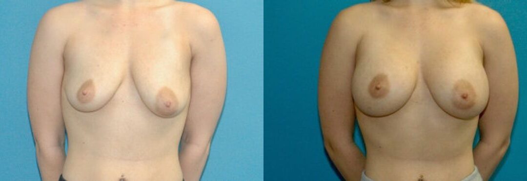 Breast Implant #73