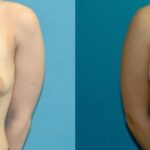 Breast Implant #73 - Before and After