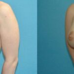 Breast Implant #73 - Before and After