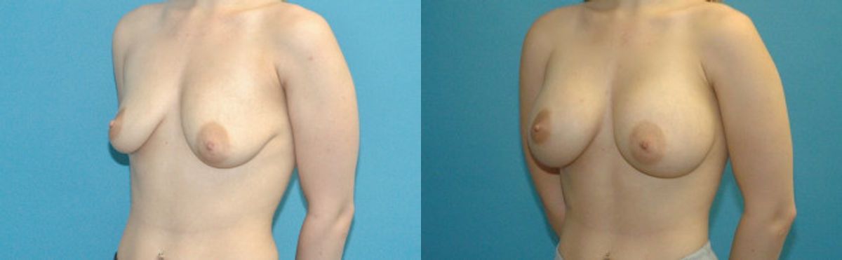 Breast Implant #73 - Before and After