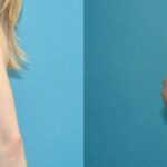 Breast Implant #73 - Before and After