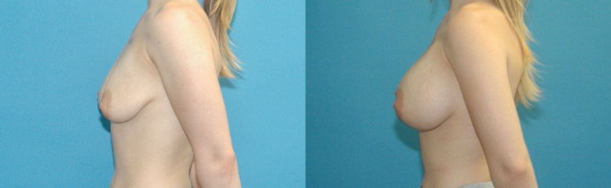 Breast Implant #73 - Before and After