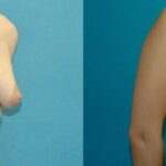 Breast Implant #73 - Before and After