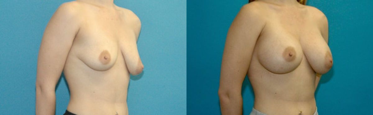 Breast Implant #73 - Before and After