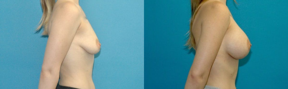 Breast Implant #73 - Before and After