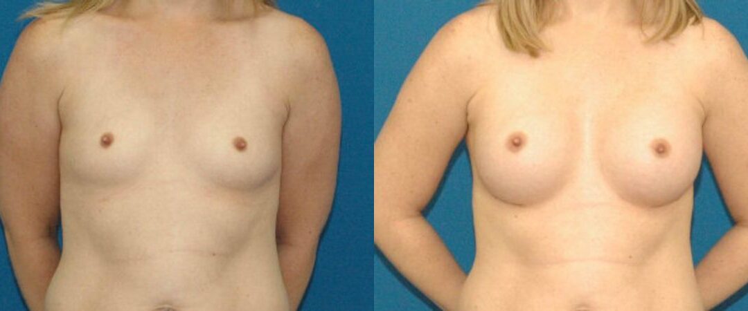 Breast Implant #74
