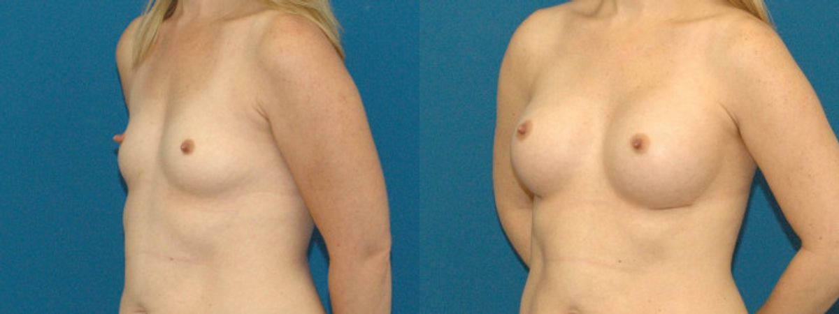 Breast Implant #74 - Before and After