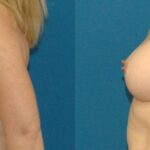 Breast Implant #74 - Before and After