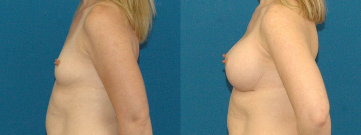 Breast Implant #74 - Before and After