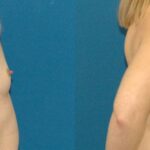 Breast Implant #74 - Before and After