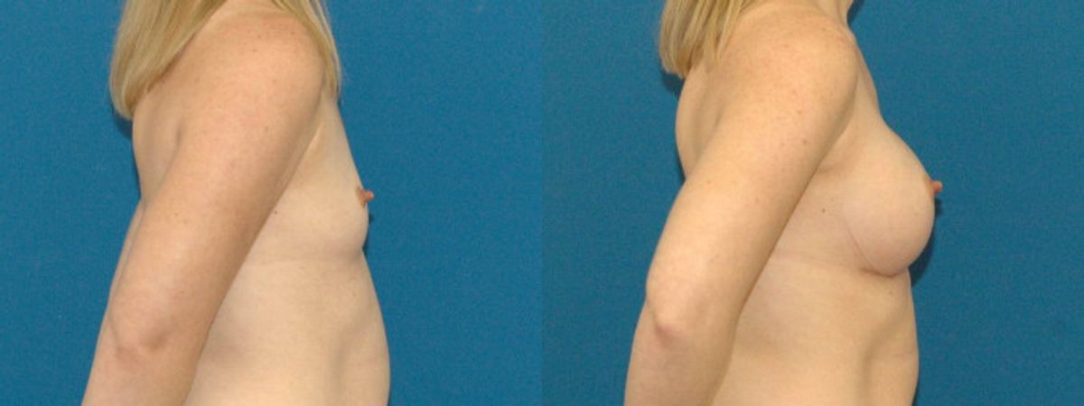 Breast Implant #74 - Before and After