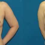 Breast Implant #75 - Before and After