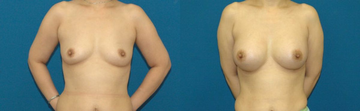 Breast Implant #75 - Before and After