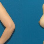 Breast Implant #75 - Before and After