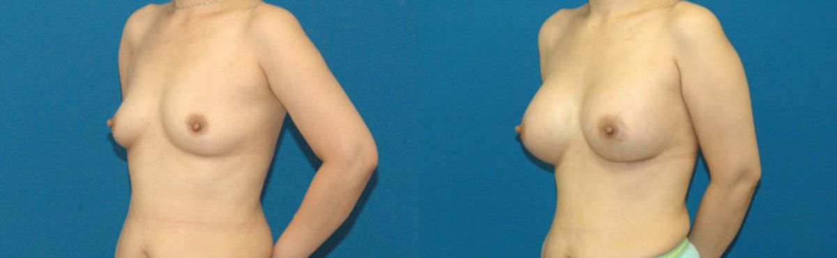 Breast Implant #75 - Before and After