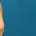 Breast Implant #75 - Before and After