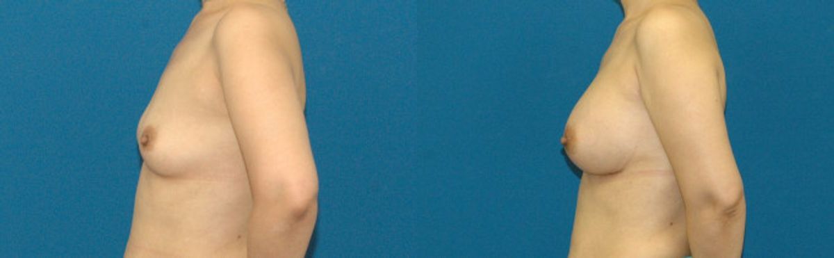 Breast Implant #75 - Before and After