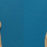 Breast Implant #75 - Before and After