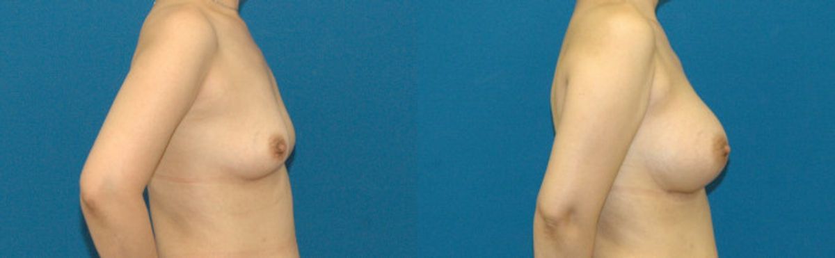 Breast Implant #75 - Before and After