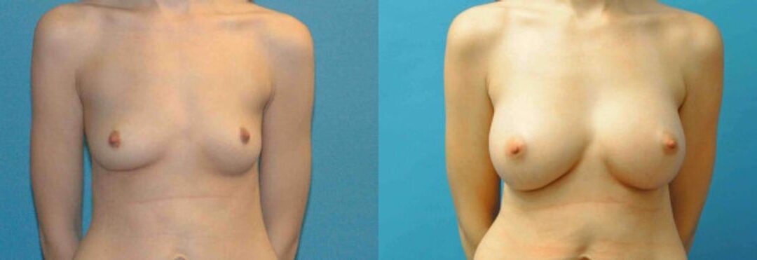 Breast Implant #76