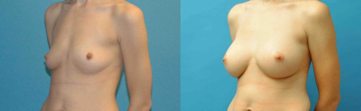 Breast Implant #76 - Before and After