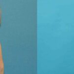 Breast Implant #76 - Before and After