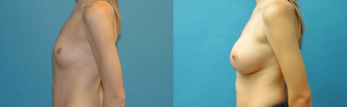 Breast Implant #76 - Before and After