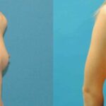 Breast Implant #76 - Before and After