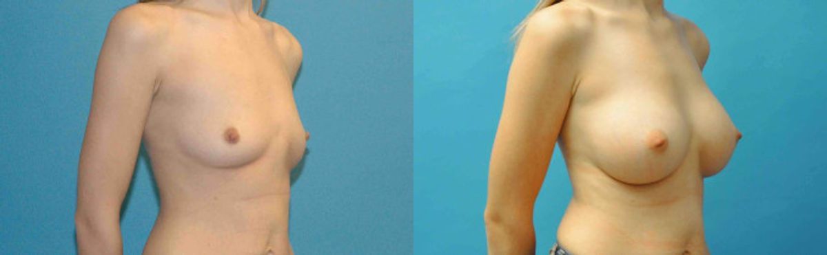 Breast Implant #76 - Before and After