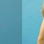 Breast Implant #76 - Before and After