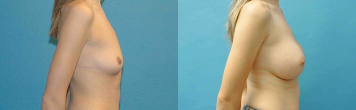 Breast Implant #76 - Before and After