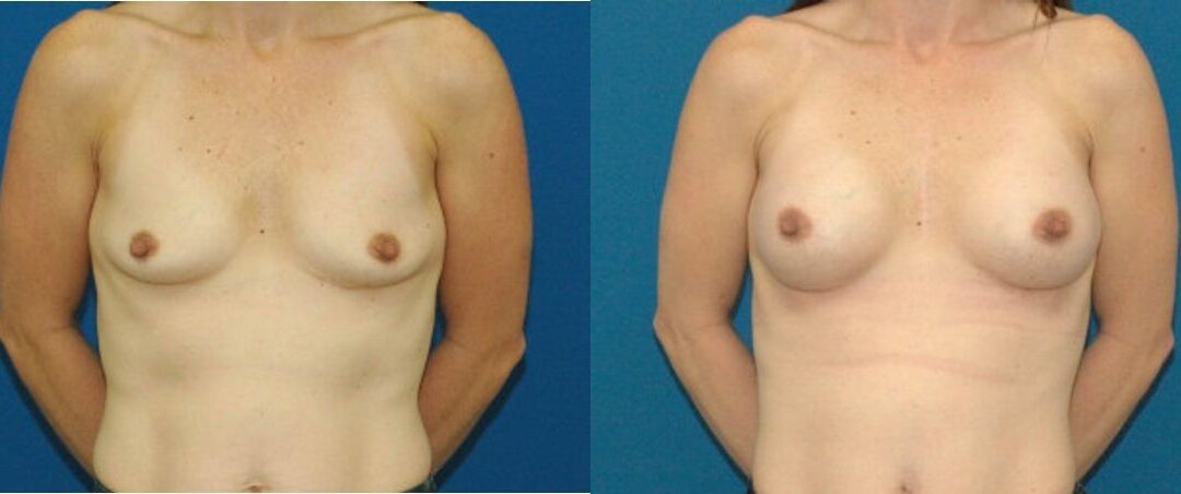 Breast Implant #77