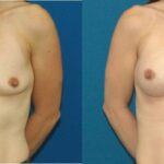 Breast Implant #77 - Before and After