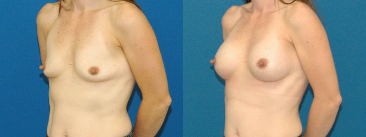 Breast Implant #77 - Before and After