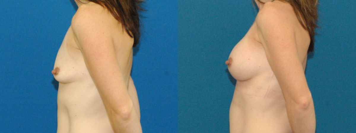 Breast Implant #77 - Before and After