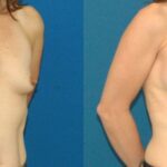 Breast Implant #77 - Before and After