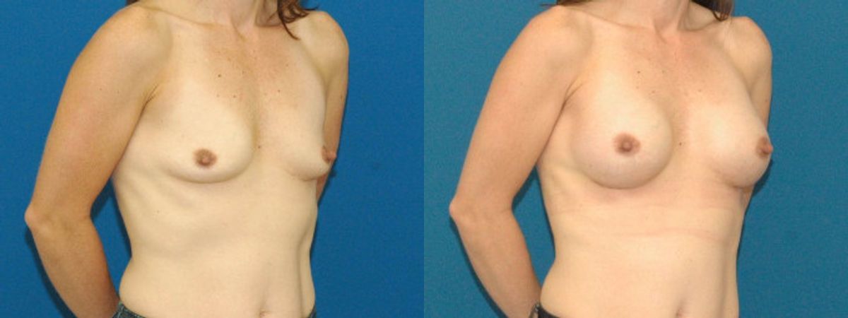 Breast Implant #77 - Before and After