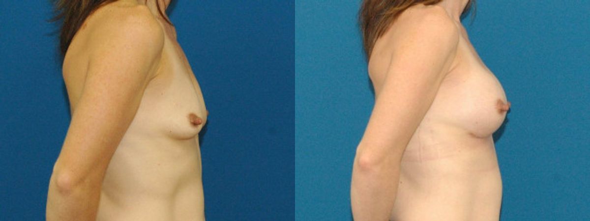 Breast Implant #77 - Before and After